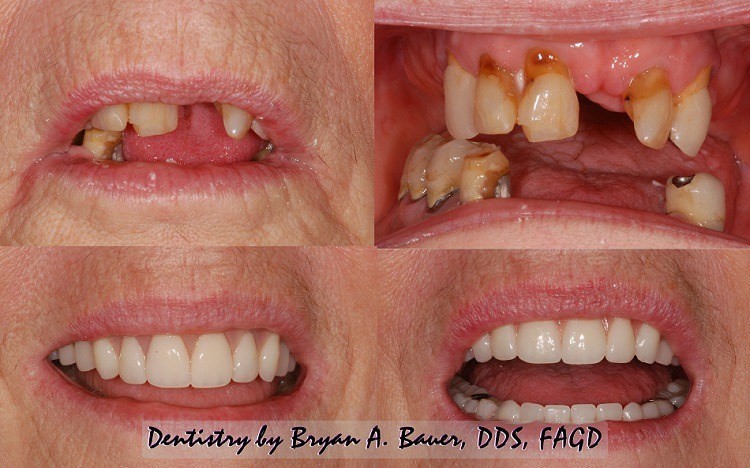 Wax Try In 
      Dentures Inez TX 77968